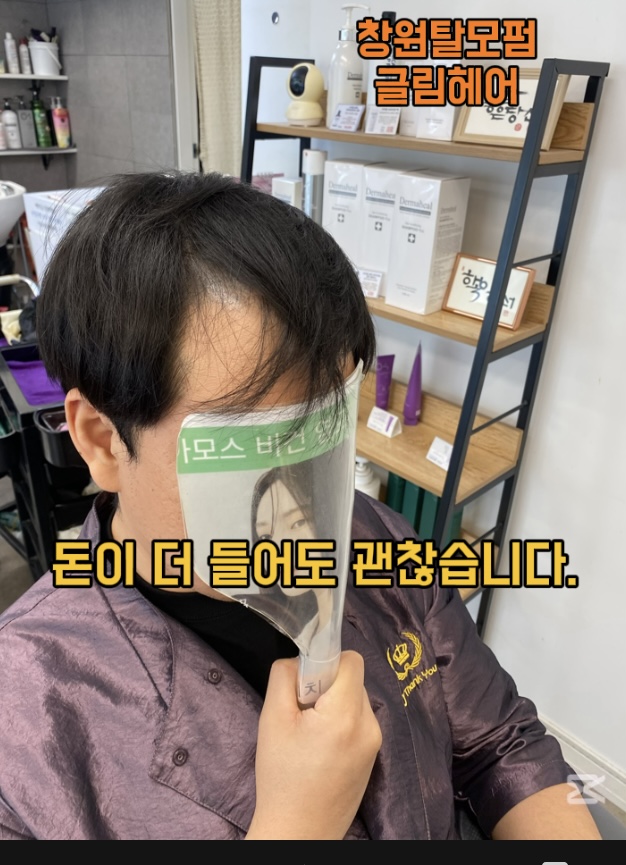 시술 전 — M자 탈모커버