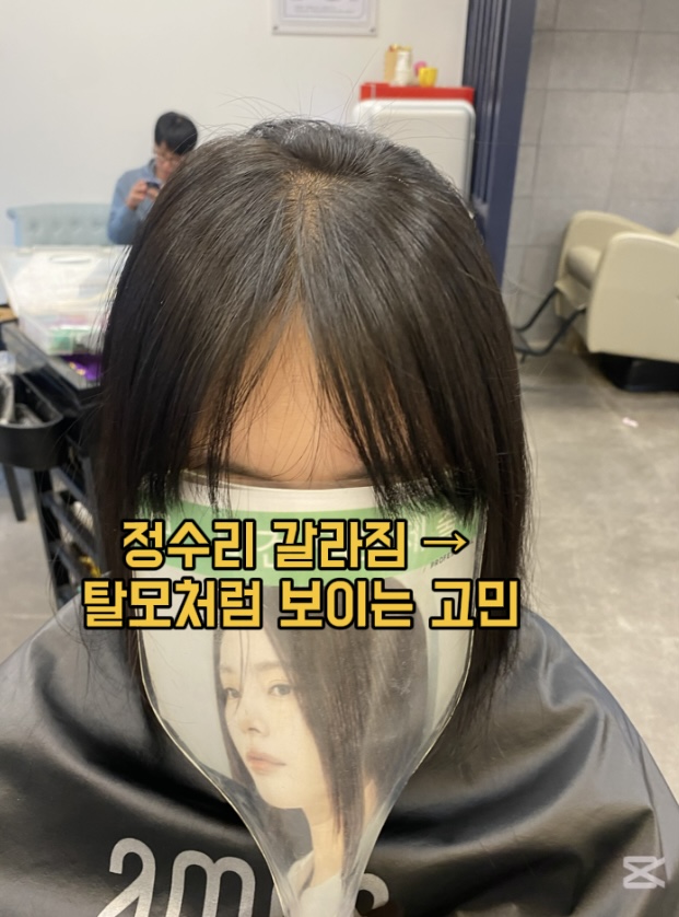 시술 후 — 정수리 가르마 교정