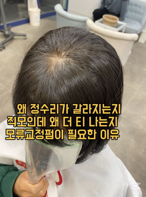 시술 전 — 정수리 가르마 교정