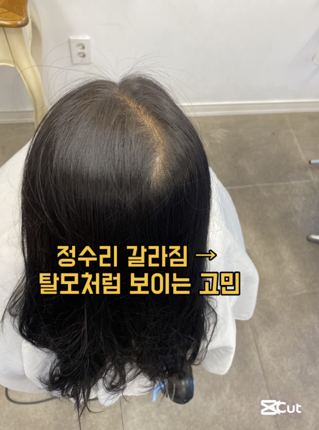 시술 전 — 정수리 볼륨 교정